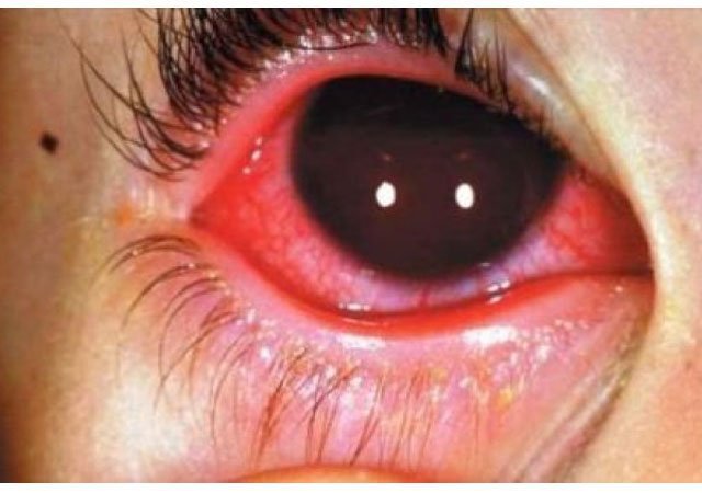 CONJUNCTIVITIS