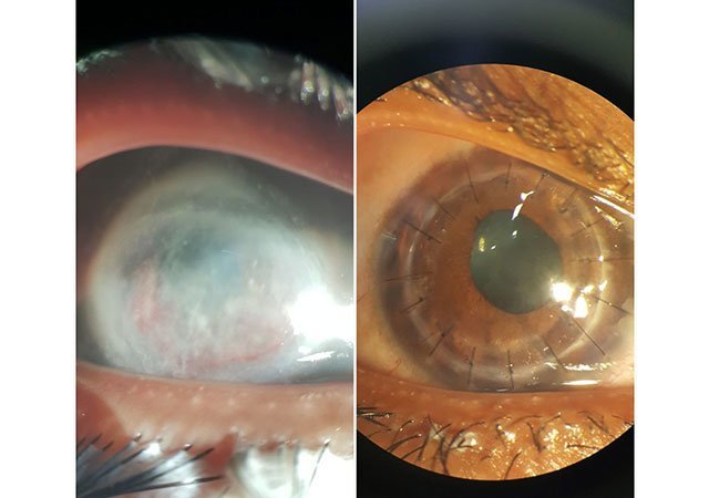 LASIK COMPLICATION MANAGEMENT