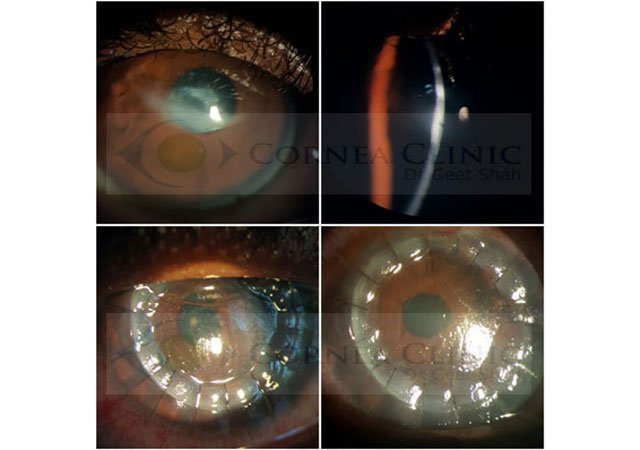 DALK (Deep Anterior Lamellar Keratoplasty)