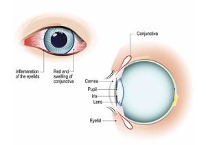 Eye Allergies - Cornea Clinic